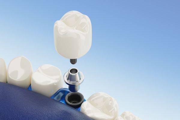 Chất liệu implant quyết định đến chi phí  